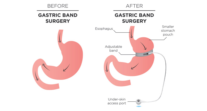 gastric band surgery weight loss surgery gastric lap band surgery