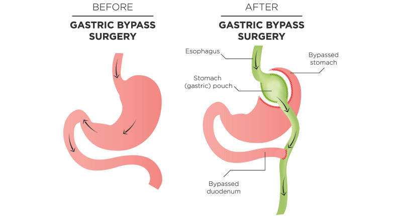 gastric bypass surgery weight loss surgery