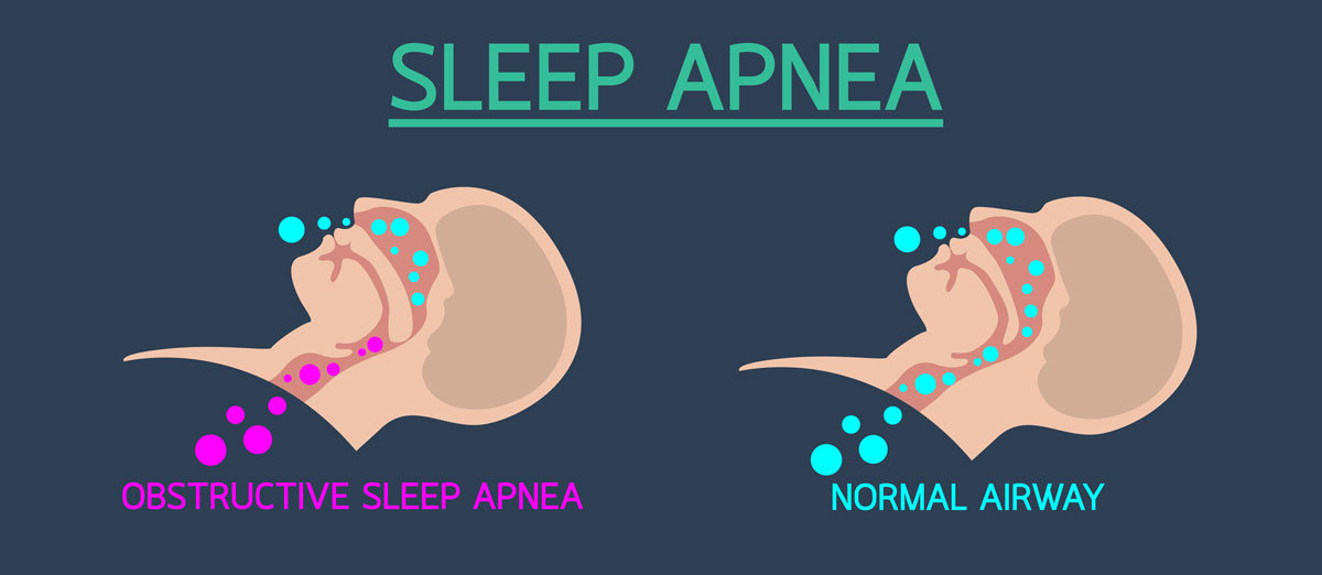 Sleep-Apnoea—Diagram-final